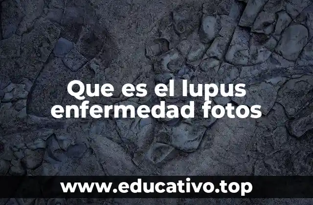 Que es el lupus enfermedad fotos