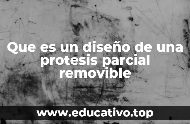 Que es un diseño de una protesis parcial removible